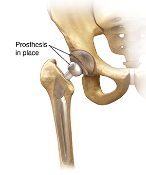 Front view of hip joint with total prosthesis in place.