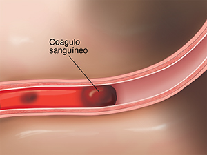 Corte transversal de una arteria en el cerebro, donde se ve una embolia que bloquea el flujo sanguíneo.