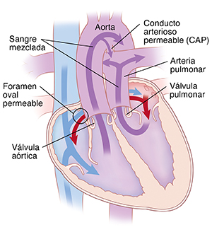 Corte transversal de vista frontal de un corazón en donde se ve las transposición de las grandes arterias. La aorta está encima del ventrículo derecho y la arteria pulmonar está encima del ventrículo izquierdo. También se ve el conducto arterioso permeable y el agujero oval permeable. Las flechas muestran la circulación de la sangre en ambas direcciones entre el lado izquierdo y el derecho del corazón a través del agujero oval permeable. La sangre mezclada sale del corazón a través de la aorta y la arteria pulmonar.