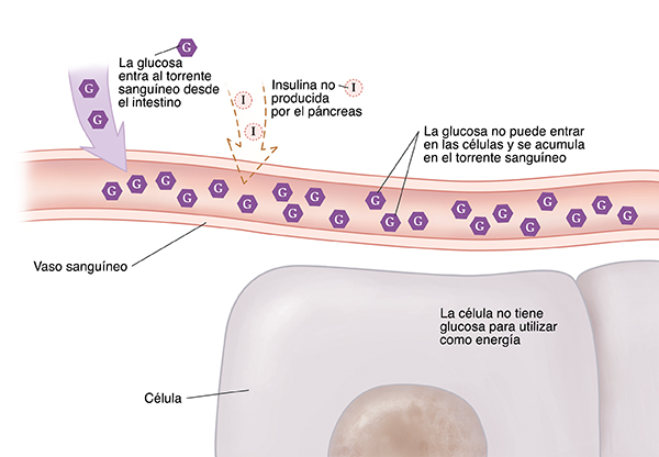 Primer plano de un corte transversal de un vaso sanguíneo cerca de células donde se muestra la diabetes tipo 1. No se produce insulina. La glucosa no puede entrar en las células y se acumula en el torrente sanguíneo. La célula no tiene glucosa para utilizar como energía.