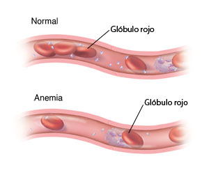 Corte transversal de un vaso sanguíneo con cantidades normales de glóbulos rojos. Abajo se ve otro corte transversal de un vaso sanguíneo que muestra que hay muy pocos glóbulos rojos debido a una anemia.