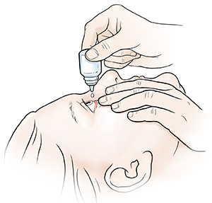 Mujer que inclina la cabeza hacia atrás y baja suavemente el párpado inferior. Con la otra mano, sostiene un frasco de gotas oftálmicas por encima del ojo.